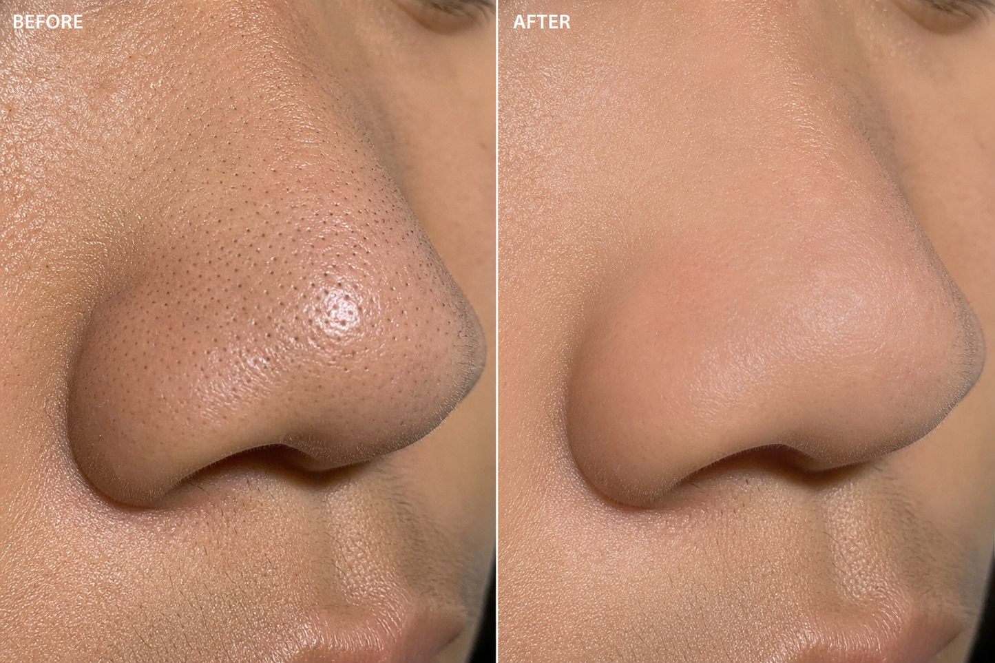 Before and after — blackheads and pores, visibly clearer