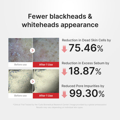Fewer blackheads and whiteheads — clinical results: -99.3% pore impurities