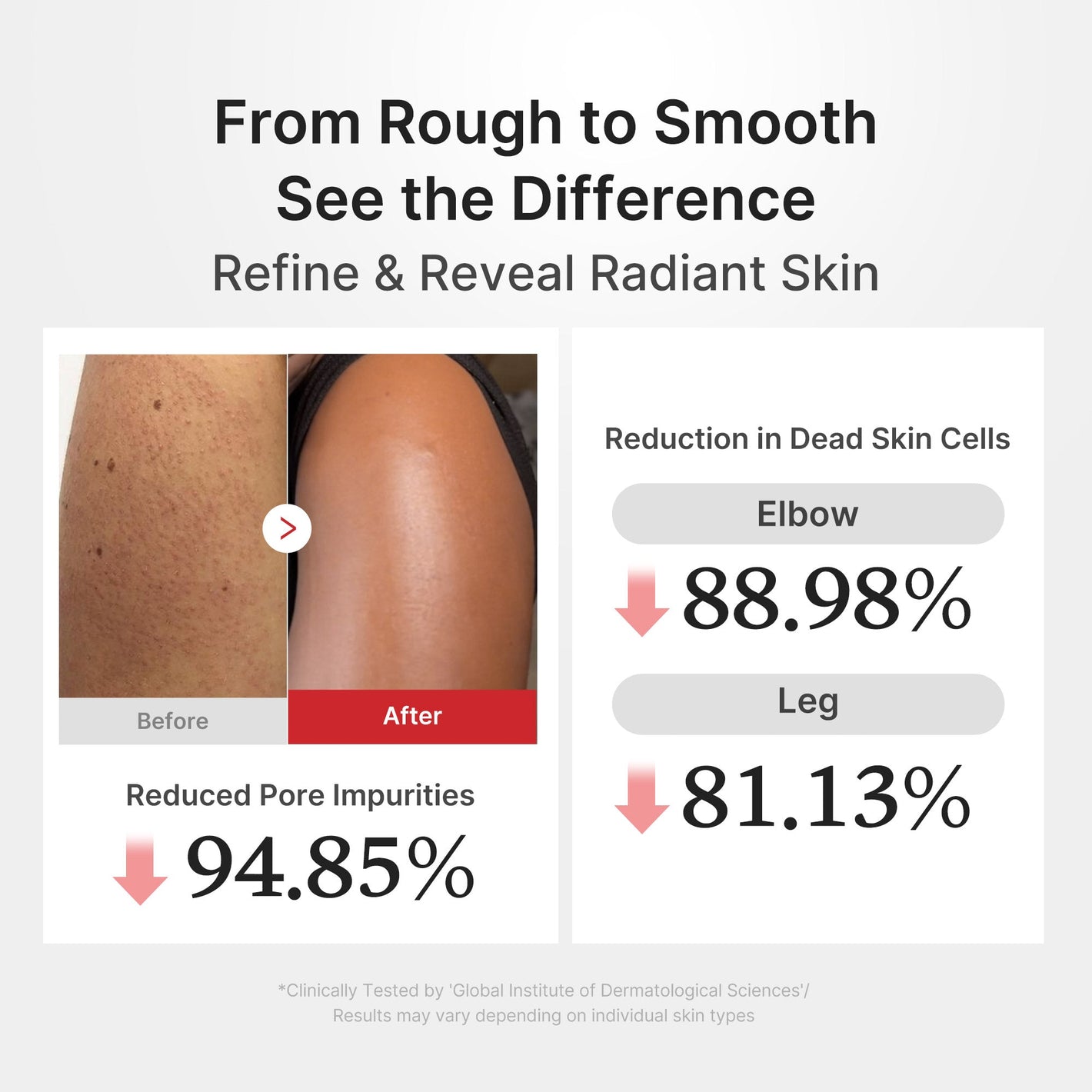 From rough to smooth — clinical results: -88.98% dead skin on elbows