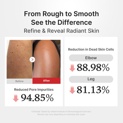 From rough to smooth — clinical results: -88.98% dead skin on elbows