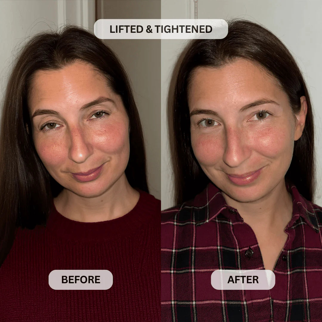 Multi-Peptide Micro-Infusion System 2.0 GHK-Cu + PDRN + NAD⁺ For Hooded Eyelids