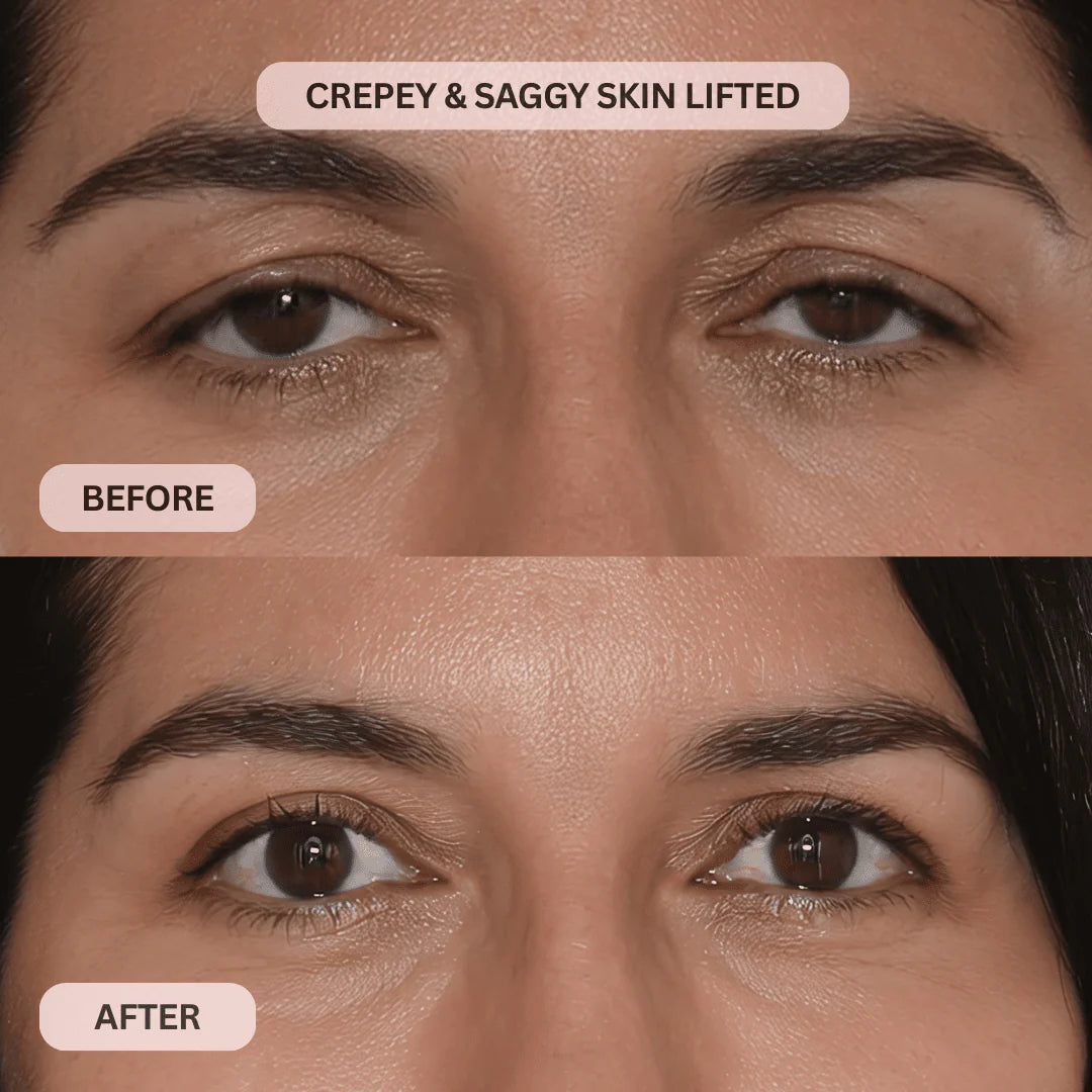 Multi-Peptide Micro-Infusion System 2.0 GHK-Cu + PDRN + NAD⁺ For Hooded Eyelids