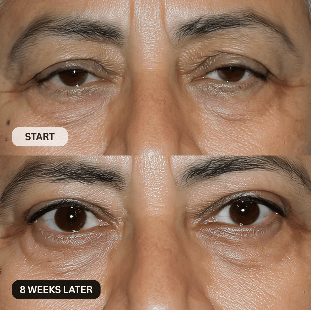 Multi-Peptide Micro-Infusion System 2.0 GHK-Cu + PDRN + NAD⁺ For Hooded Eyelids