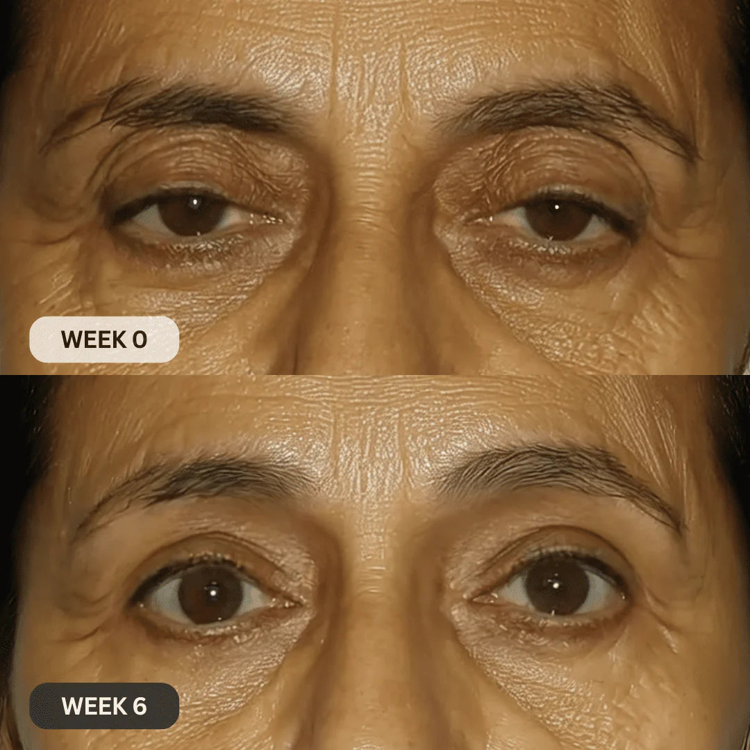 Multi-Peptide Micro-Infusion System 2.0 GHK-Cu + PDRN + NAD⁺ For Hooded Eyelids