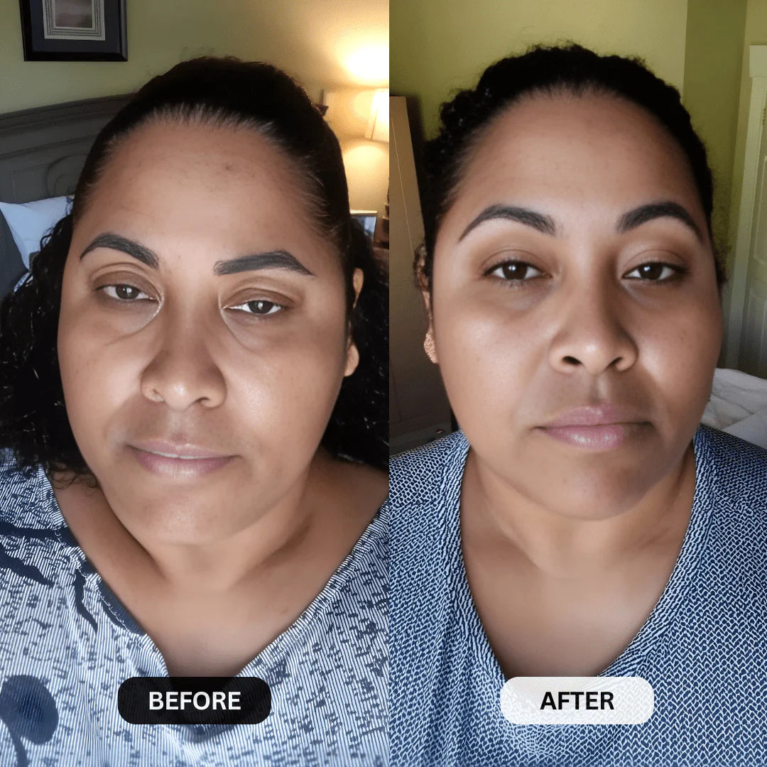 Multi-Peptide Micro-Infusion System 2.0 GHK-Cu + PDRN + NAD⁺ For Hooded Eyelids