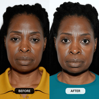 Multi-Peptide Micro-Infusion System 2.0 GHK-Cu + PDRN + NAD⁺ For Hooded Eyelids