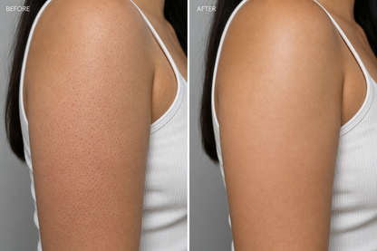 Before and after — strawberry skin on arms, visibly smoother