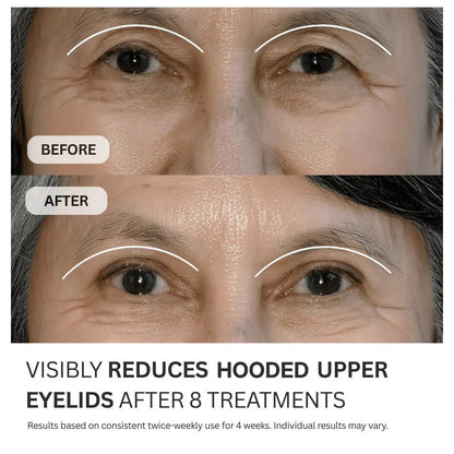 Multi-Peptide Micro-Infusion System 2.0 GHK-Cu + PDRN + NAD⁺ For Hooded Eyelids